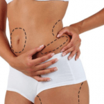Liposuctia – solutia chirurgicala pentru a ajunge la dimensiunile ideale
