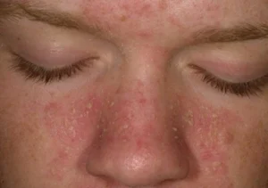 Dermatita seboreică: diagnostic, complicații și prevenție